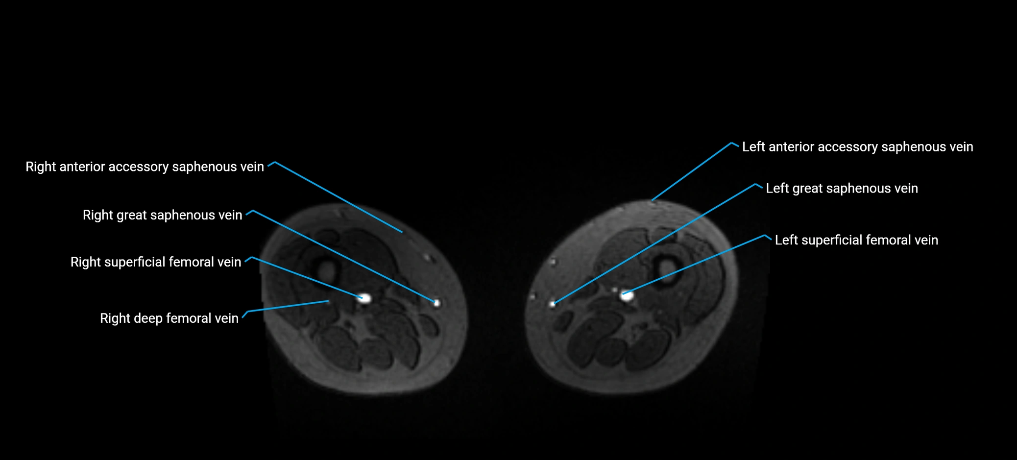 MRV abdomen pelvis & lower limb axial cross sectional anatomy labelled MRI image 302 (1).webp